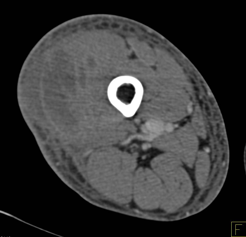 Thigh Abscess - CTisus CT Scan