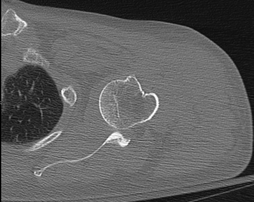 Fracture Dislocation of the Left Shoulder with Avulsed Fragment - CTisus CT Scan