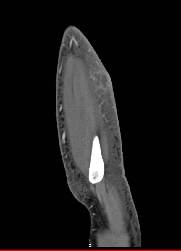 Cellulitis with Focal Abscess - CTisus CT Scan