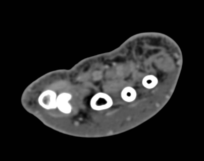Cystic Changes Carpal Bones with Soft Tissue Swelling due to Repeated Trauma - CTisus CT Scan