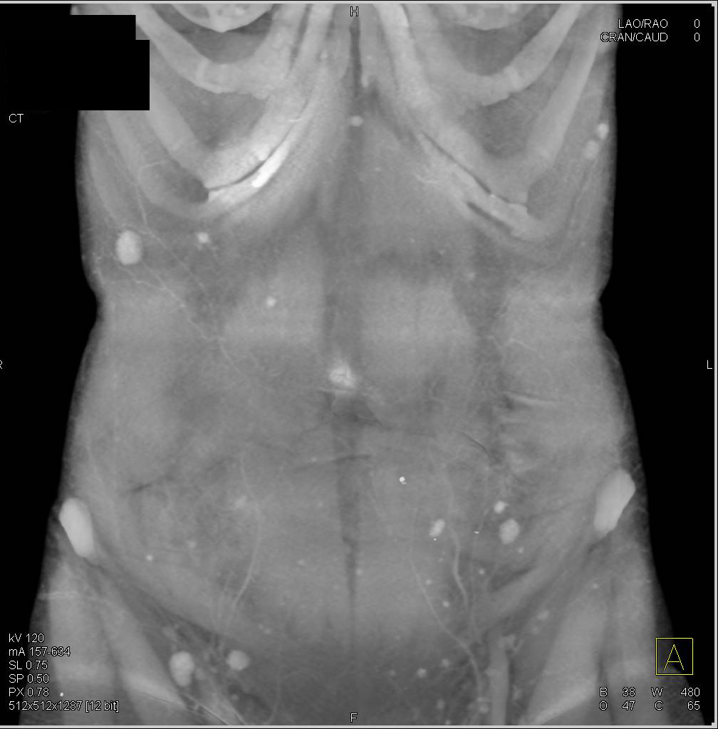 Metastatic Melanoma to Skin, Liver, Pancreas and Adenopathy - CTisus CT Scan