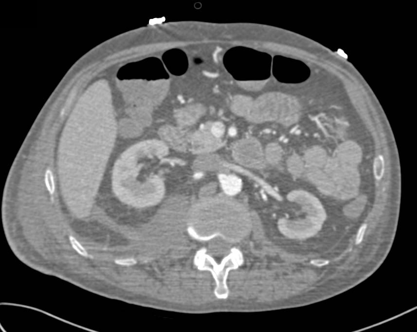 Retroperitoneal Bleed - CTisus CT Scan