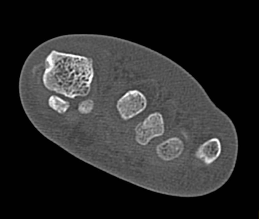 Gout - CTisus CT Scan