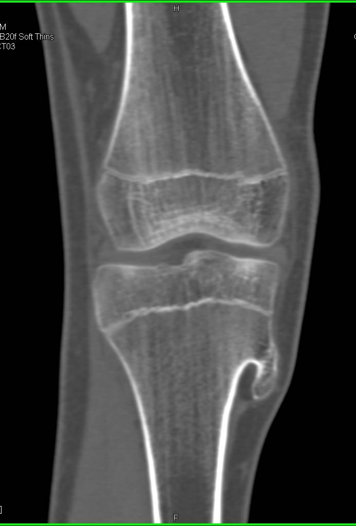 Exostosis off Tibia - CTisus CT Scan