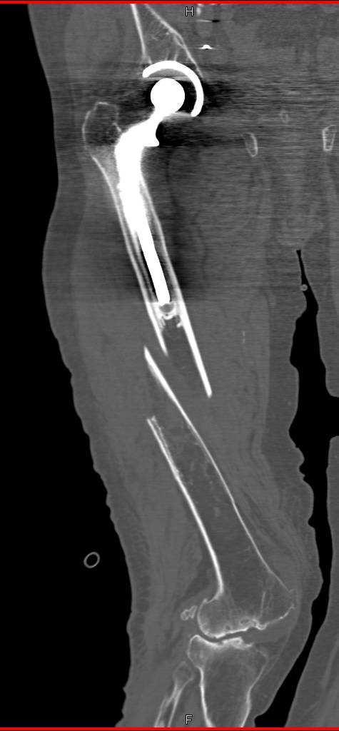 Spiral Femur Fracture Occurs Just Below Stem of Total Hip Replacement (THR) - CTisus CT Scan