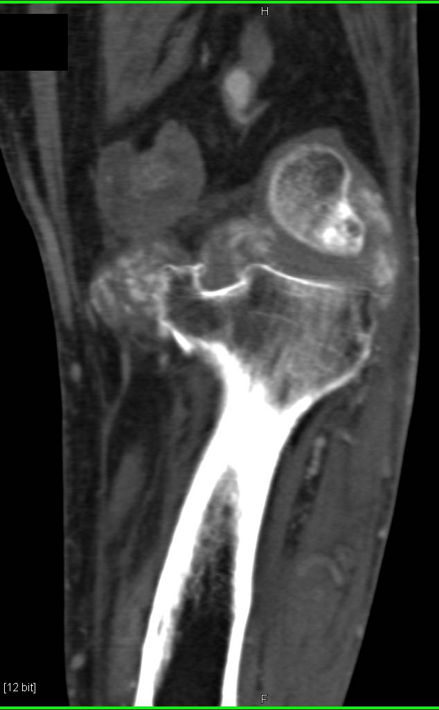 Gout - CTisus CT Scan