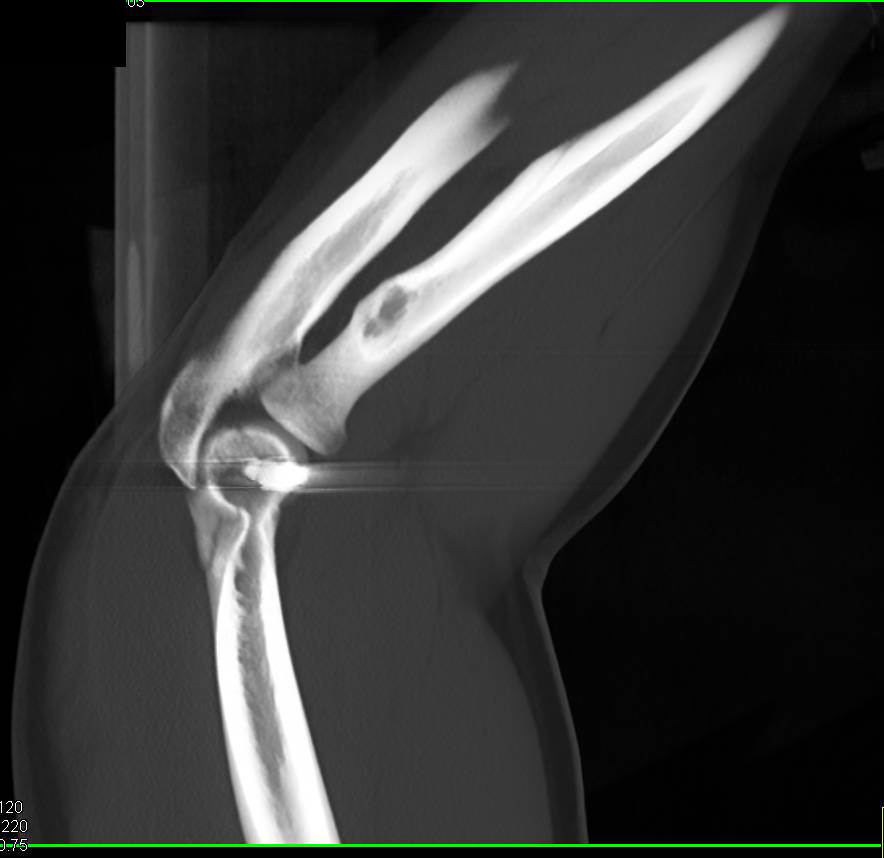 GSW Elbow with Humerus Fracture Nicely Seen in 3D - CTisus CT Scan