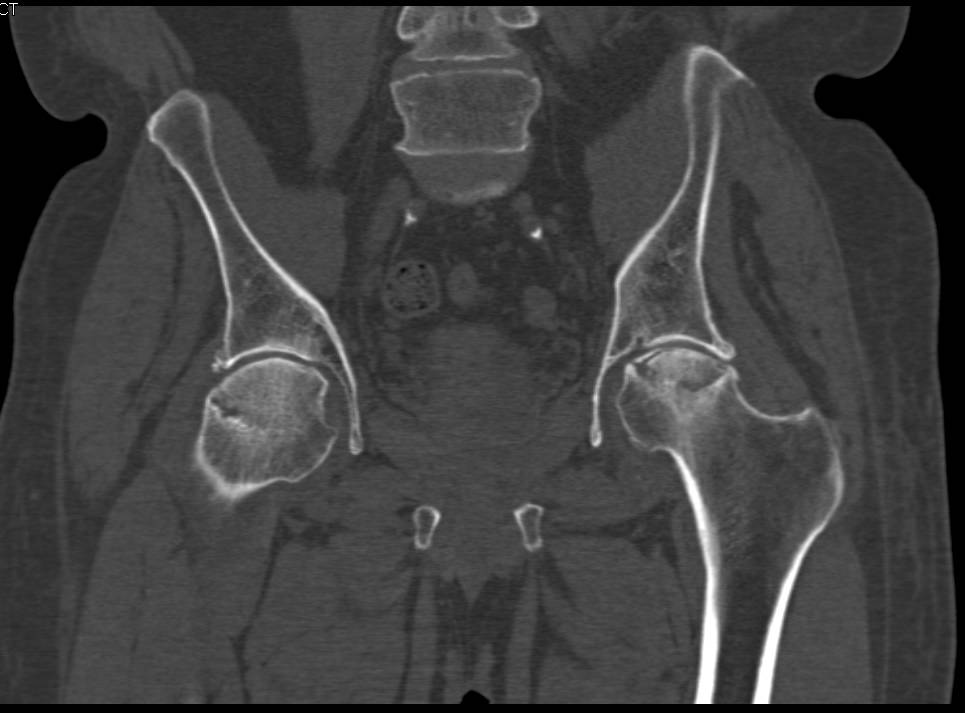 Avascular Necrosis both Femoral Heads but Worse on the Left Side - CTisus CT Scan