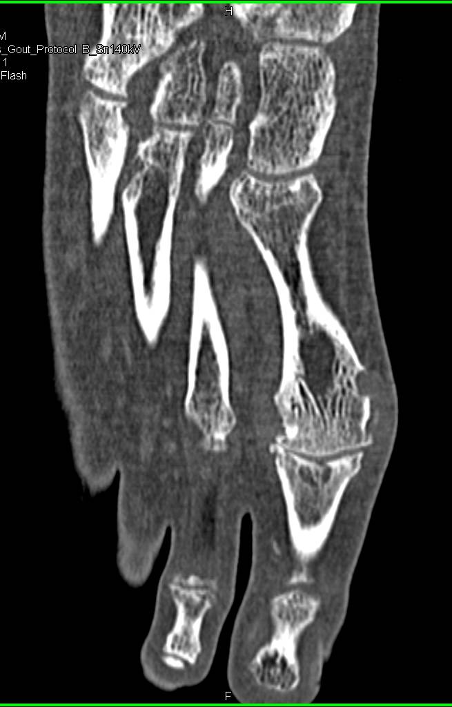Gout - CTisus CT Scan