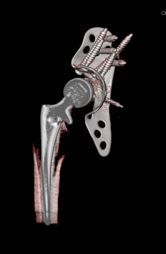 3D Mapping with Post Processing and Segmentation of Total Hip Replacement - CTisus CT Scan