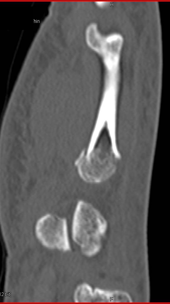 Fracture Base of 5th Metacarpal - CTisus CT Scan