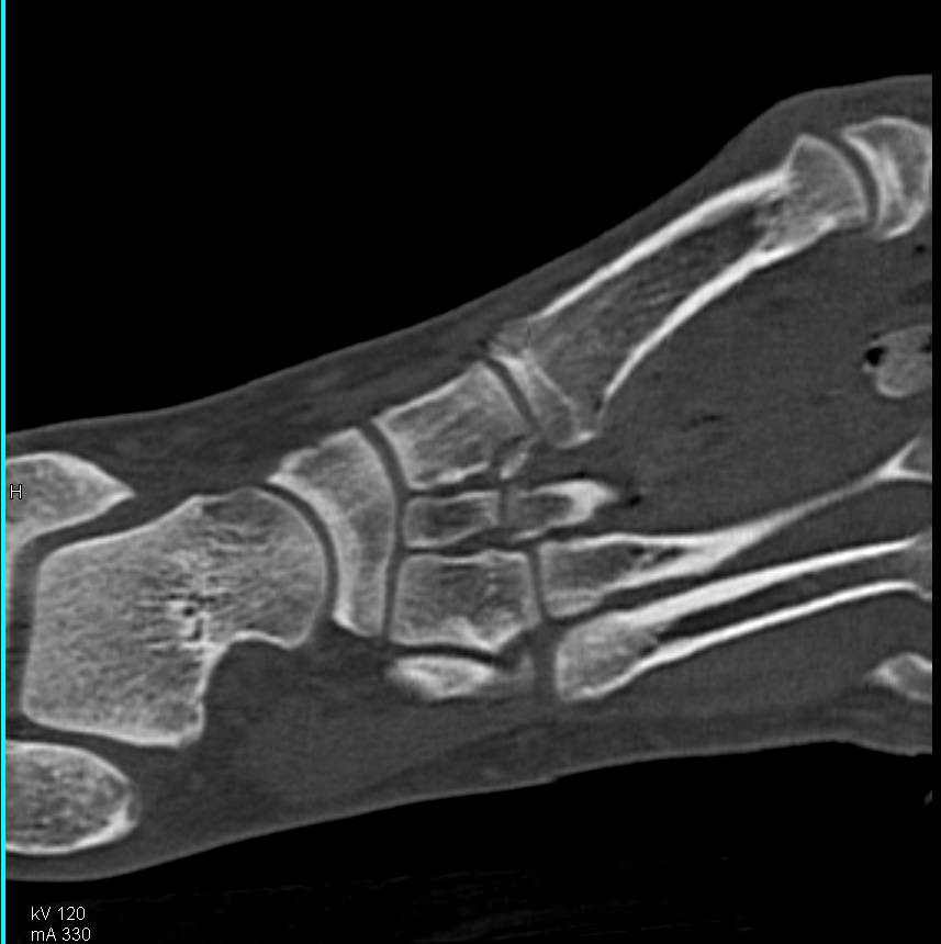 GSW Foot with Medial Cuneiform Fractures - CTisus CT Scan