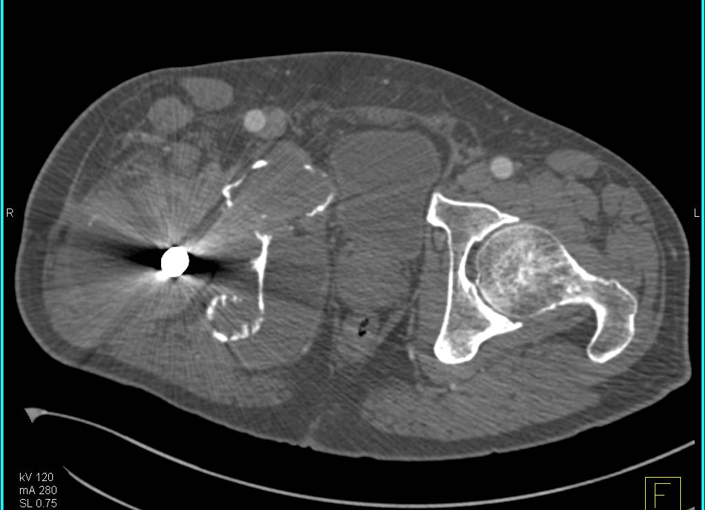 Metastatic Disease to Bone in Patient with a Total Hip Replacement - CTisus CT Scan