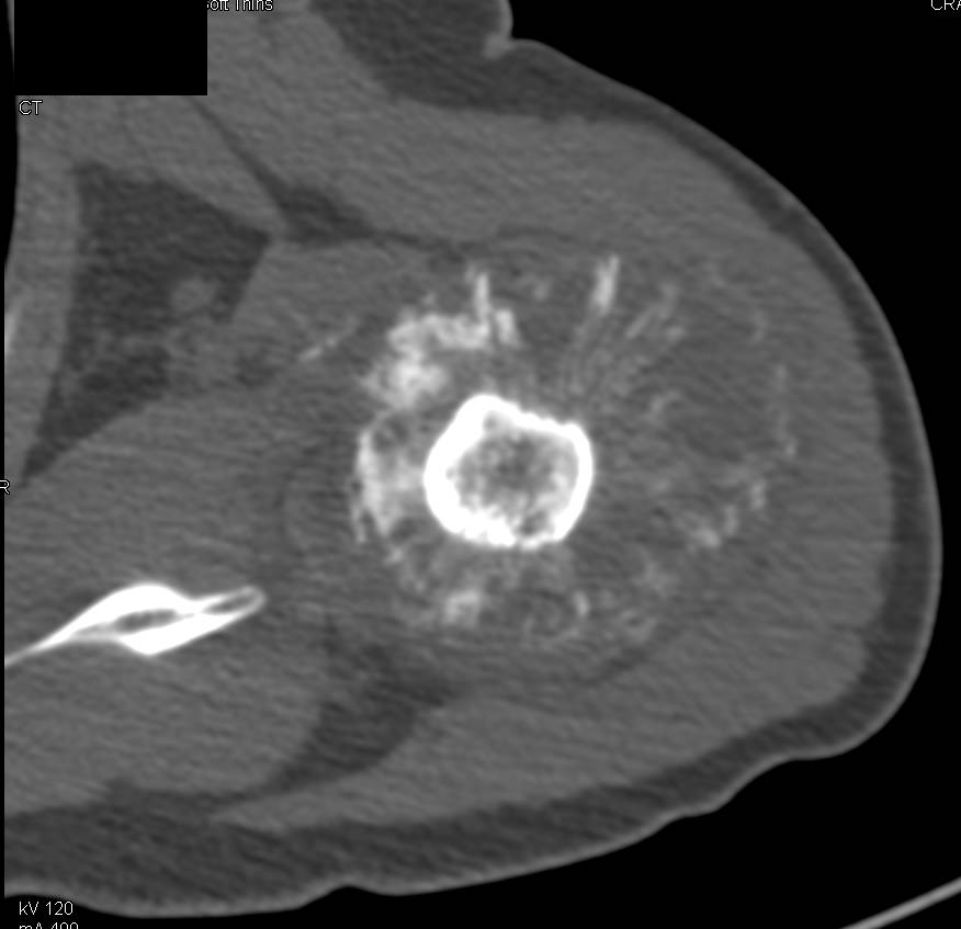 Osteosarcoma of the Humerus - CTisus CT Scan