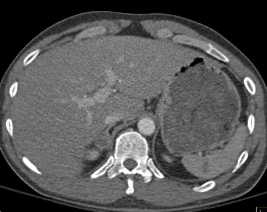 Complex Pelvic Fractures Including Sacrum and Diastasis of the Symphysis Pubis - CTisus CT Scan