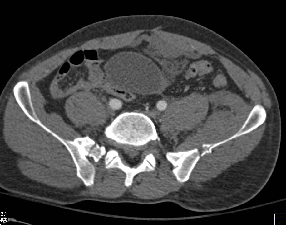 Diastasis Symphysis Pubis with Pelvic Bleed - CTisus CT Scan