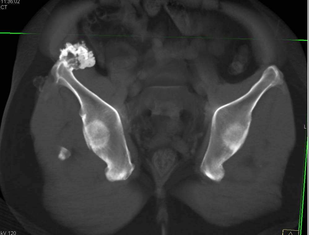 Excellent Example of Multiple Hereditary Exostosis with Remodeling of the Femoral Heads - CTisus CT Scan