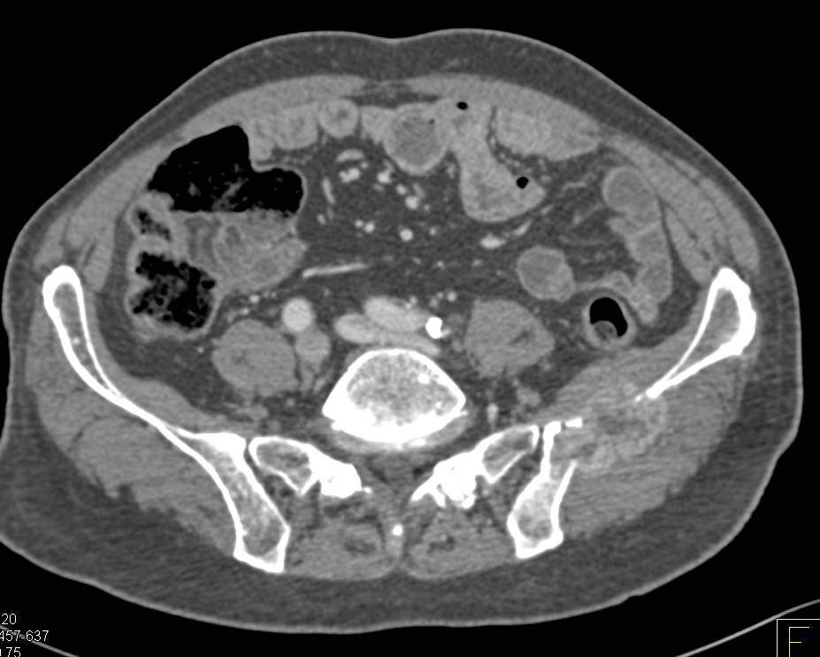 Metastatic Renal Cell Carcinoma to Bone - CTisus CT Scan