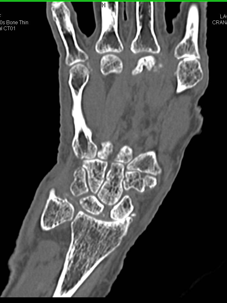 Chondrocalcinosis Wrist with Degenerative Joint Disease (DJD) - CTisus CT Scan