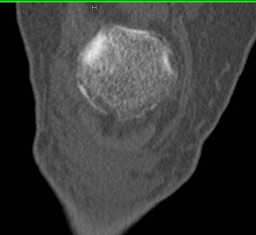 Multiple Fractures Including Patella, Talus and Calcaneus - CTisus CT Scan