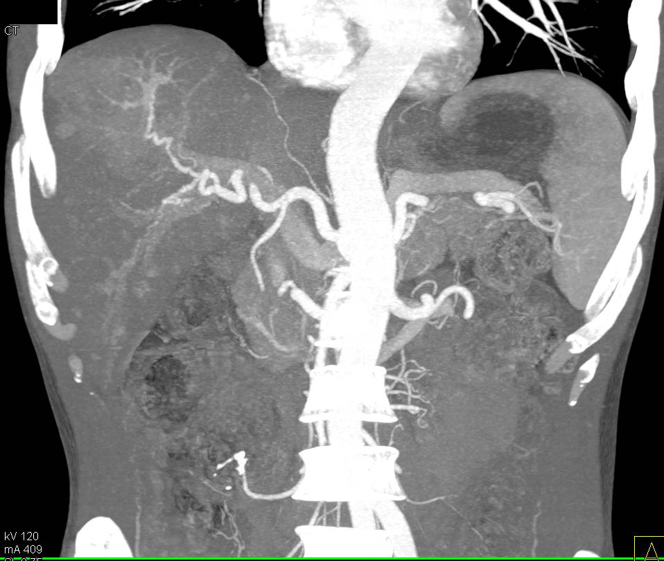 Liposarcoma Right Buttocks - CTisus CT Scan