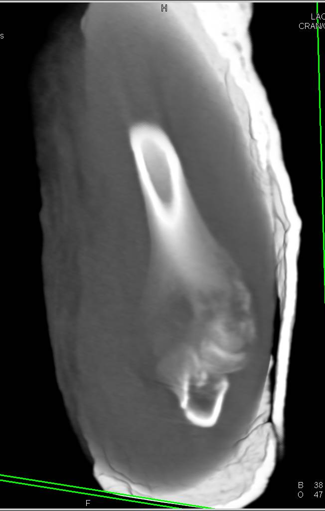 Humerus Fracture - CTisus CT Scan