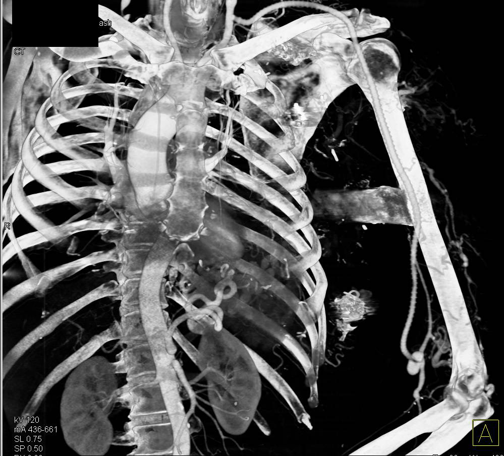 Arteriovenous Malformation (AVM) Left Chest Wall with Collaterals and Bypass Graft s/p Embolization - CTisus CT Scan