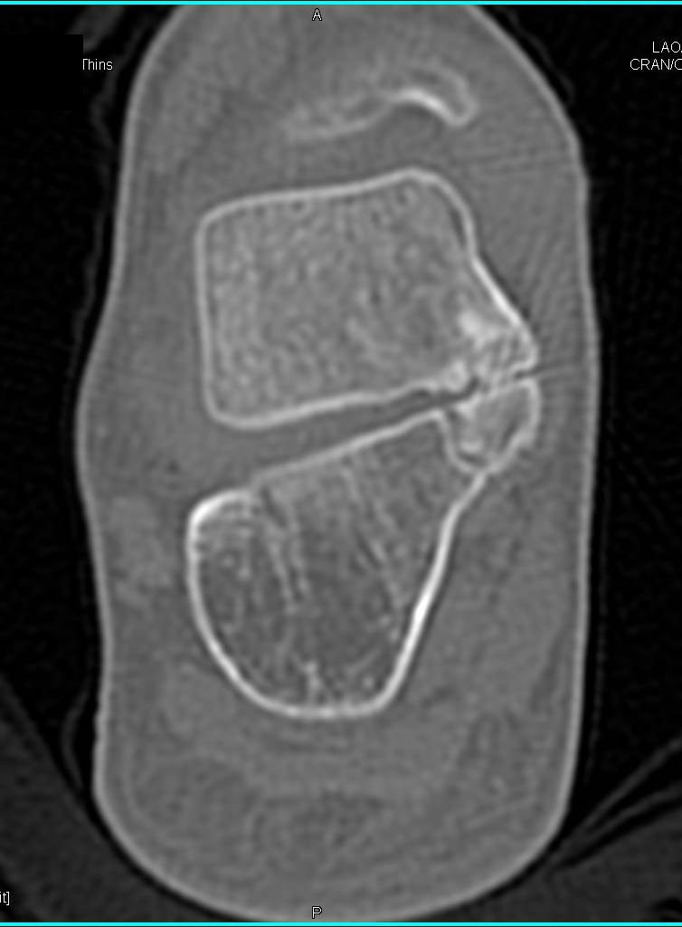 Tarsal Coalition - CTisus CT Scan