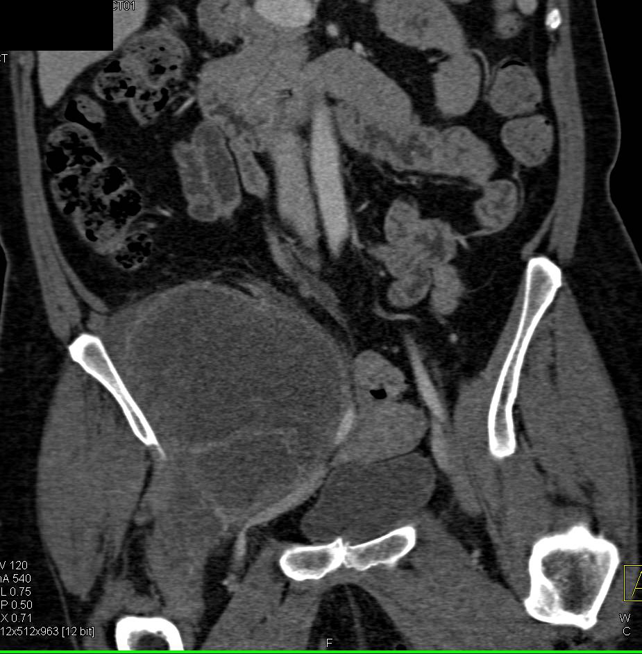 Tumor Infiltrates the Right Psoas and Iliopsoas Muscle - CTisus CT Scan
