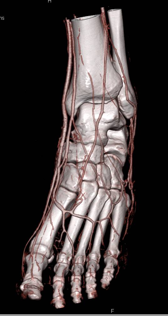 Normal CTA of the Foot - CTisus CT Scan