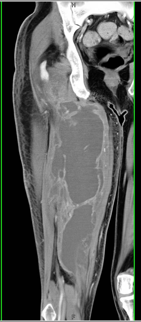 Intramuscular Abscess in the Thigh - CTisus CT Scan