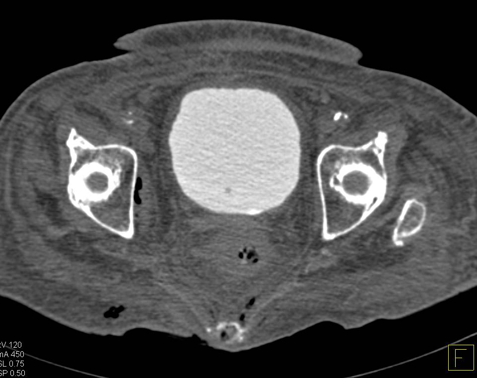 Necrotizing Fasciitis - CTisus CT Scan