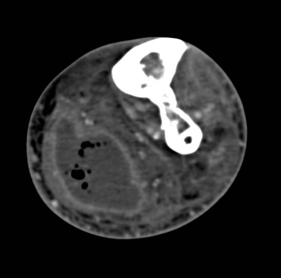 Calf Abscess - CTisus CT Scan