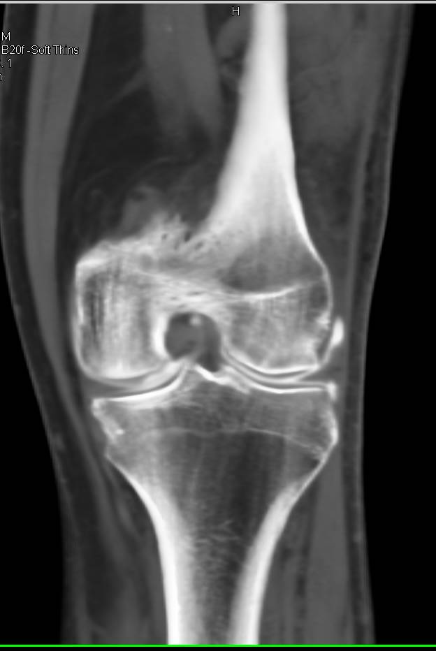 CT Arthrogram Knee with Meniscal Injury - CTisus CT Scan