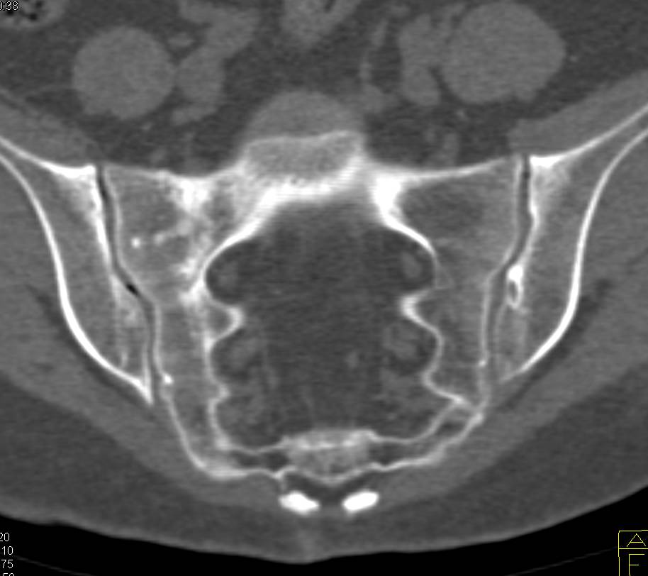 Stress Fracture Sacrum on the Right Side of Sacrum - CTisus CT Scan
