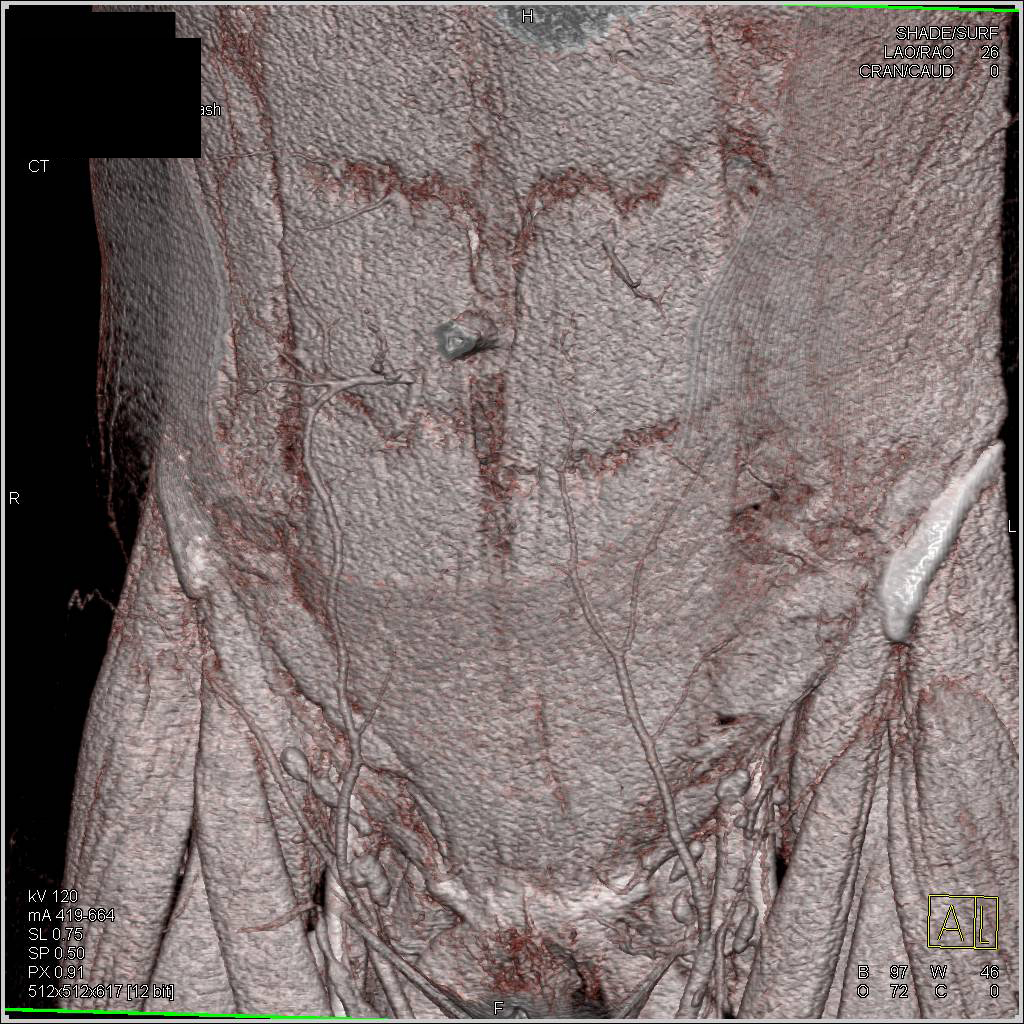 Inferior Perforators Seen in 3D (DIEP) - CTisus CT Scan