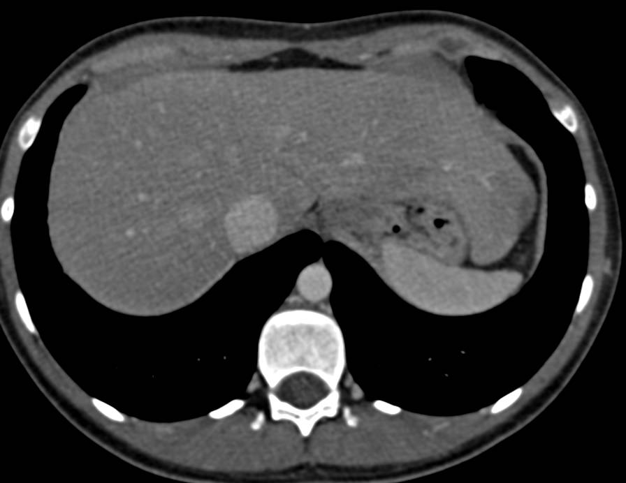 3D Relationship of Spleen, Ribs and Diaphragm - CTisus CT Scan