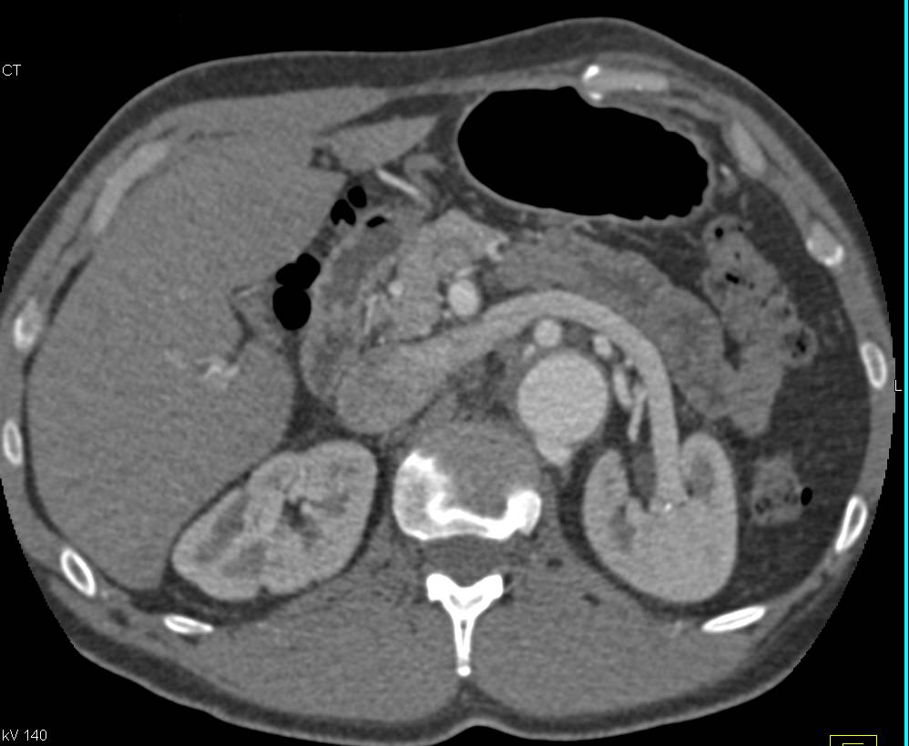 Marfan Syndrome with Dural Ectasia and Aortic Dissection - CTisus CT Scan