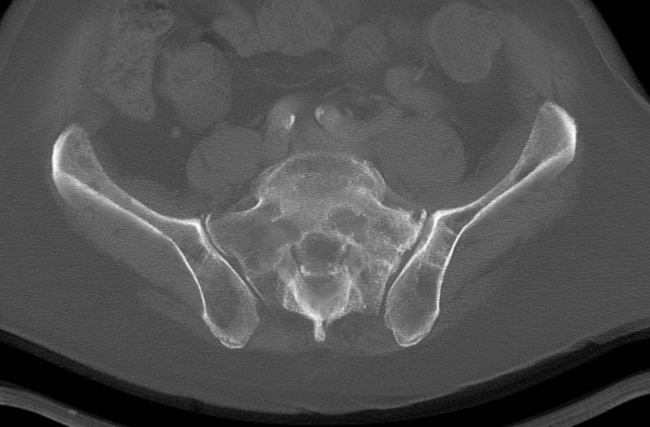 Multiple Myeloma with Lytic Bone Lesions - CTisus CT Scan