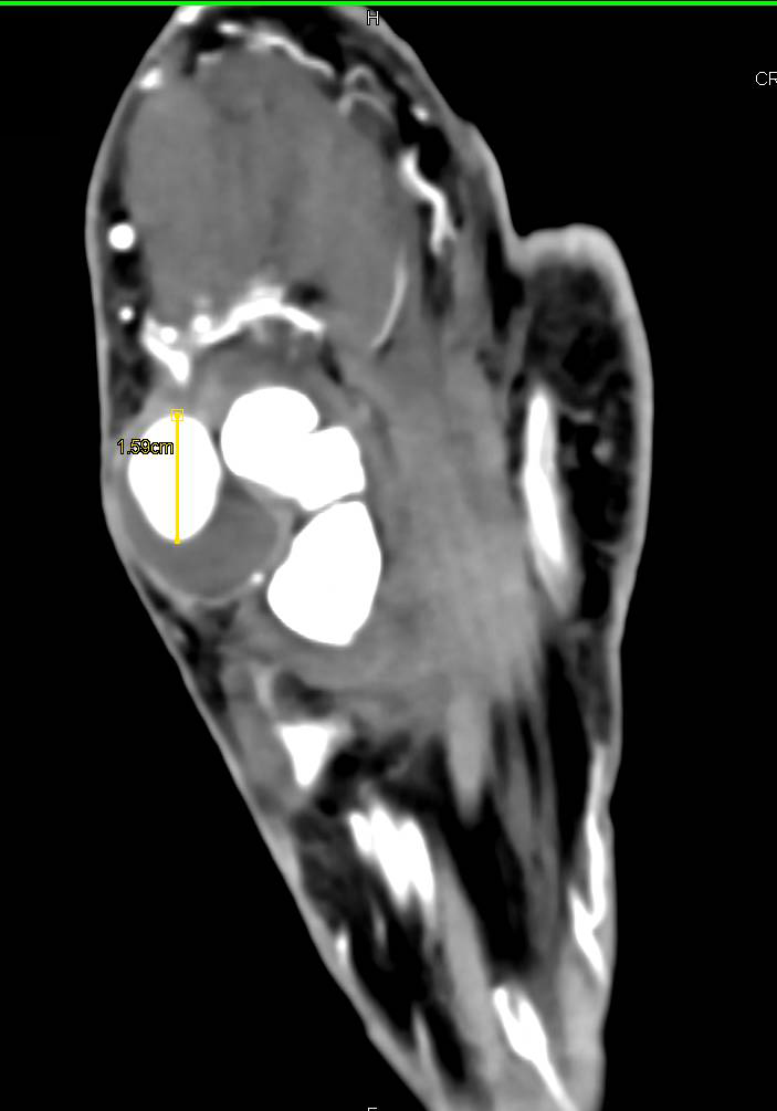 Arteriovenous Malformation (AVM) in Vascular Arcade of the Hand in Multiple 3D Projections - CTisus CT Scan