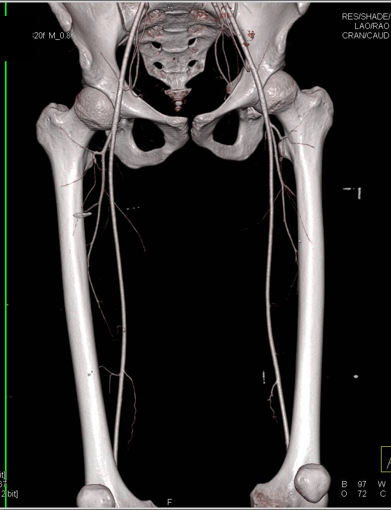 CTA Runoff with Flow Through Posterior Tibial Arteries - CTisus CT Scan
