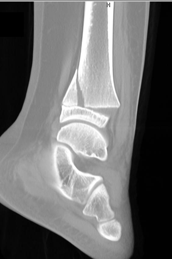 Tibial Fracture with Epiphyseal Plate Injury - CTisus CT Scan