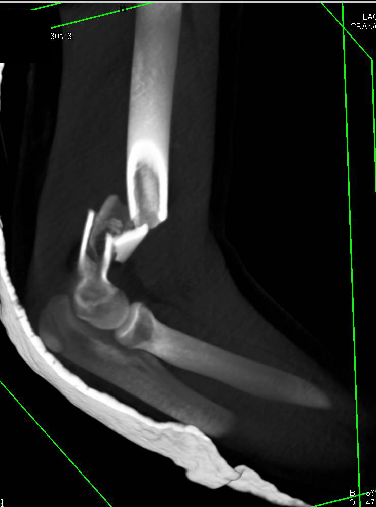 Comminuted Distal Humeral Fracture - CTisus CT Scan