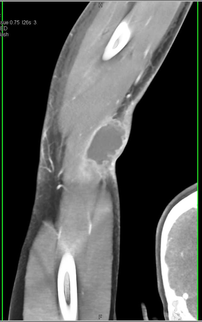 Abscess Near Elbow Joint with CTA and 3D - CTisus CT Scan