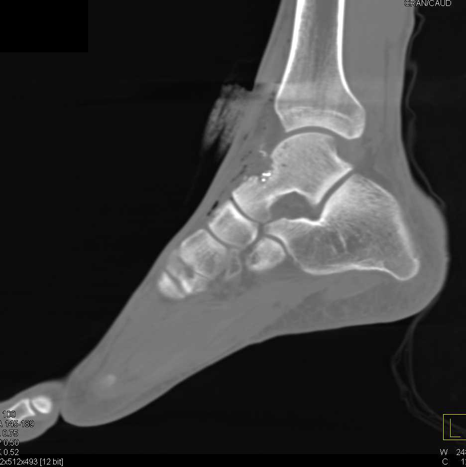 GSW to Foot with Talus Fracture - CTisus CT Scan