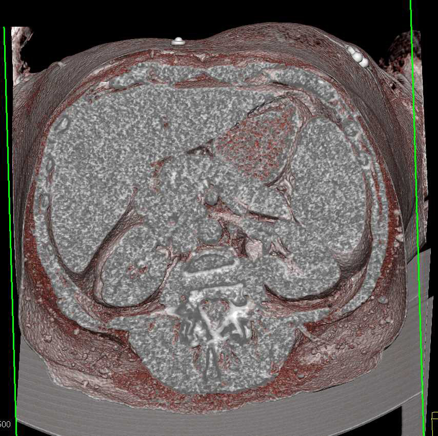 Subtle Subcutaneous Nodules due to Lymphoma - CTisus CT Scan