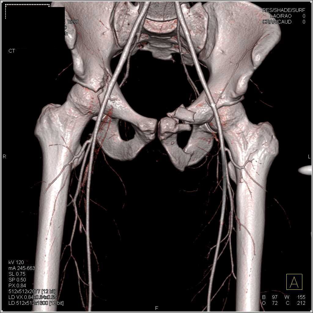 Bilateral Acetabular Fractures with Normal CTA - CTisus CT Scan