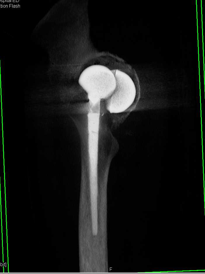 Loosening of Total Hip Prosthesis - CTisus CT Scan