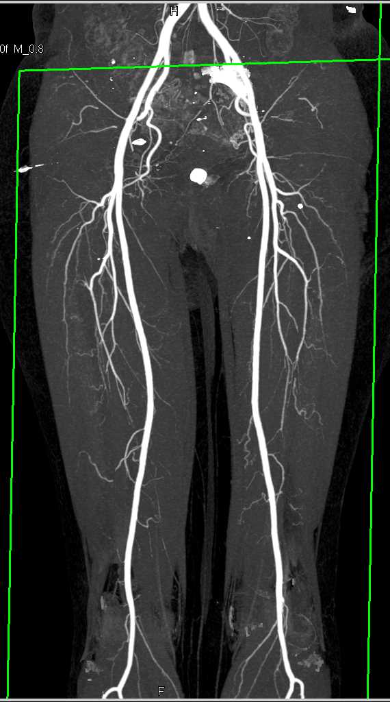 Normal DE CT Runoff - CTisus CT Scan