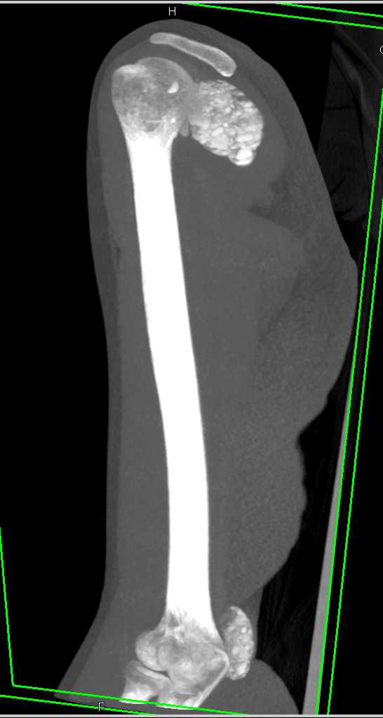 Chondrocalcinosis Near the Shoulder and Elbow Joint - CTisus CT Scan
